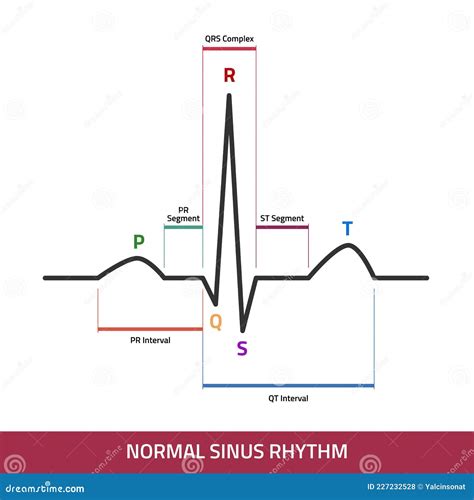 ecg nsr means|Electrocardiogram (ECG) .